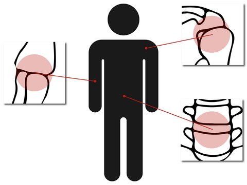 Prävention von muskuloskelettalen Beschwerden